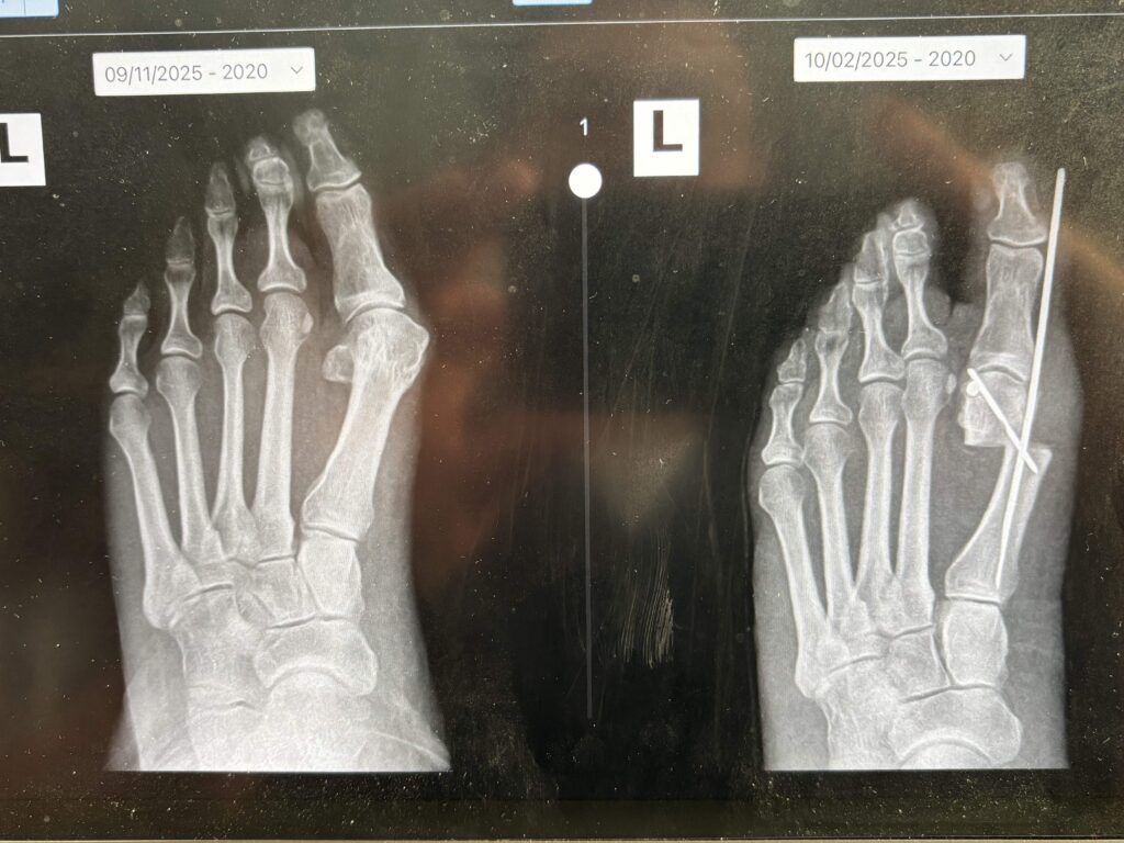 bunion-surgery-before-after-xray-topeka-ks Before and after X-rays of a left foot bunion correction using minimally invasive surgery by Dr. Timothy Gateley
